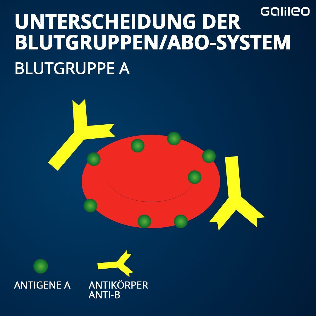 Die roten Blutkörperchen der Blutgruppe A tragen das Antigen A auf ihrer Oberfläche. Im Blut schwimmen Antikörper gegen das Antigen B.