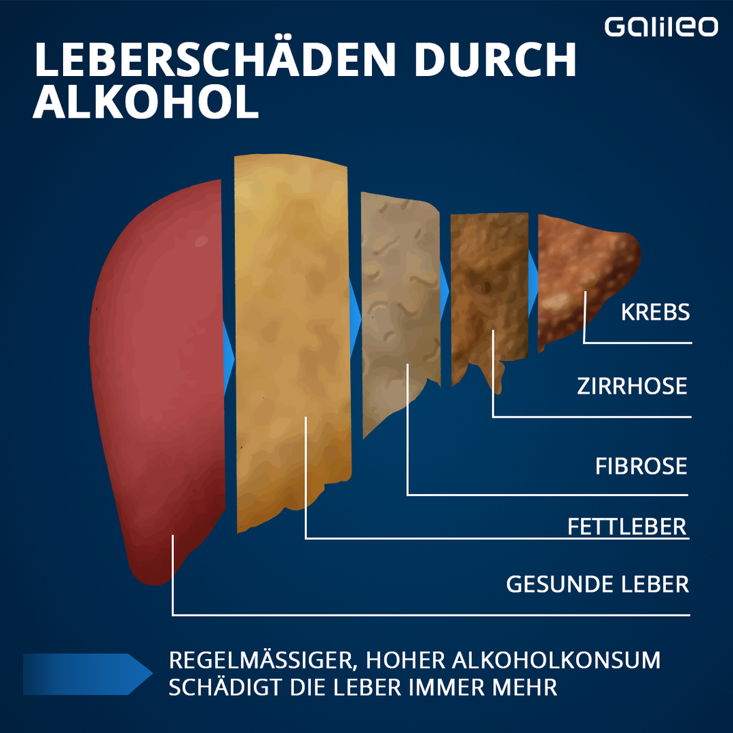 Die Leber baut den Alkohol ab und leidet besonders unter übermäßigem Konsum. Zunächst entsteht eine Fettleber. Bei weiterer Alkoholzufuhr entwickelt sich eine Fibrose, dann eine Leberzirrhose, die wiederum in Leberkrebs übergehen kann.