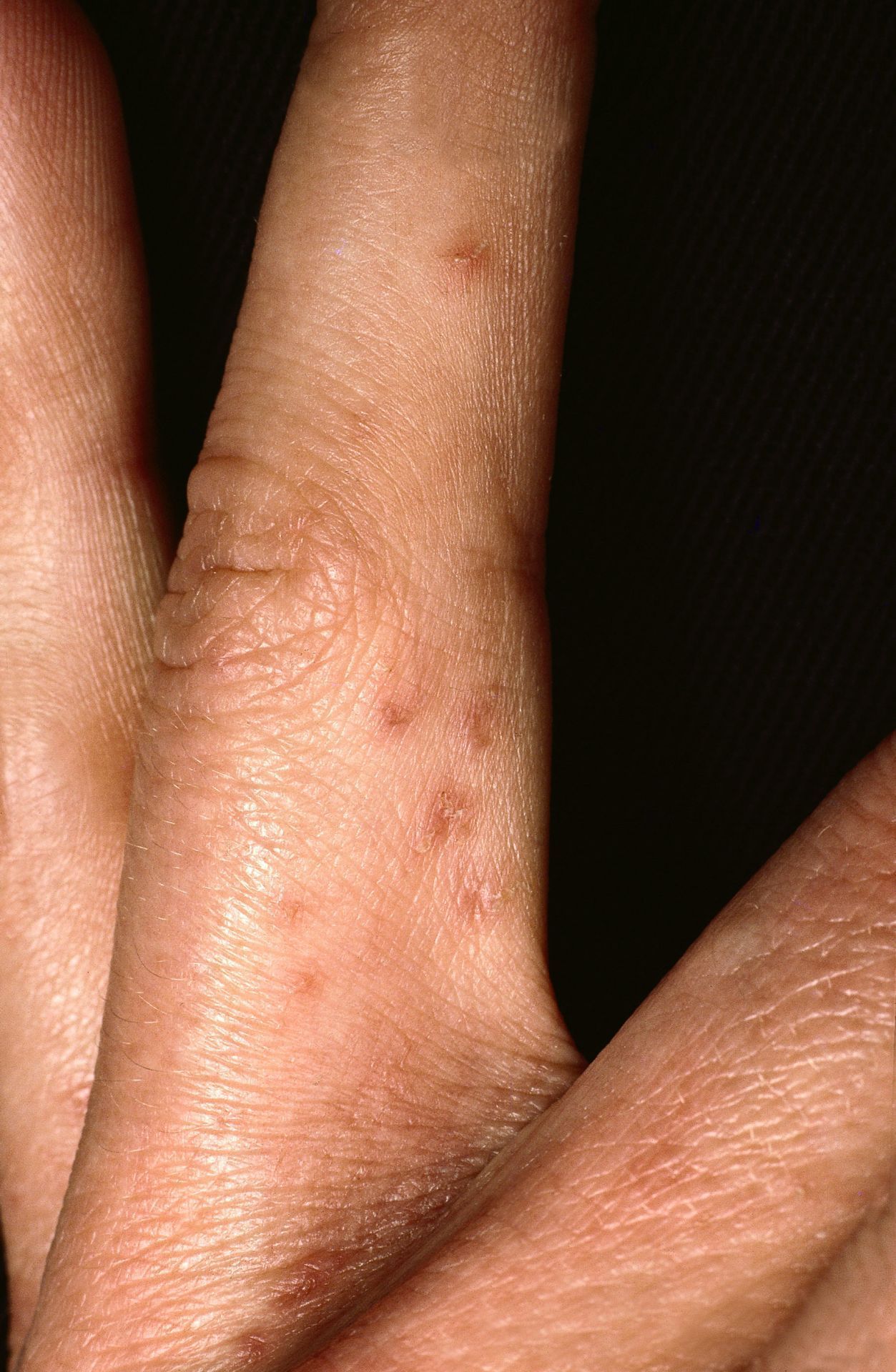 Auch zwischen den Fingern oder Zehen tritt Krätze sehr häufig auf. Von anderen Hauterkrankungen wie allergischen Reaktionen ist Skabies auf den ersten Blick oftmals schwer zu unterscheiden.