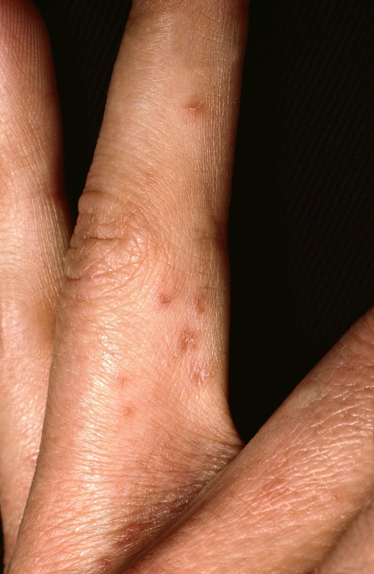Auch zwischen den Fingern oder Zehen tritt Krätze sehr häufig auf. Von anderen Hauterkrankungen wie allergischen Reaktionen ist Skabies auf den ersten Blick oftmals schwer zu unterscheiden.
