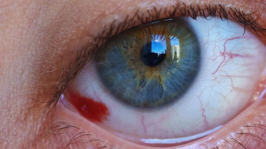 Normalerweise sind geplatzte Blutgefäße im Auge harmlos, aber in bestimmten Situationen solltest du besser ärztlichen Rat einholen.