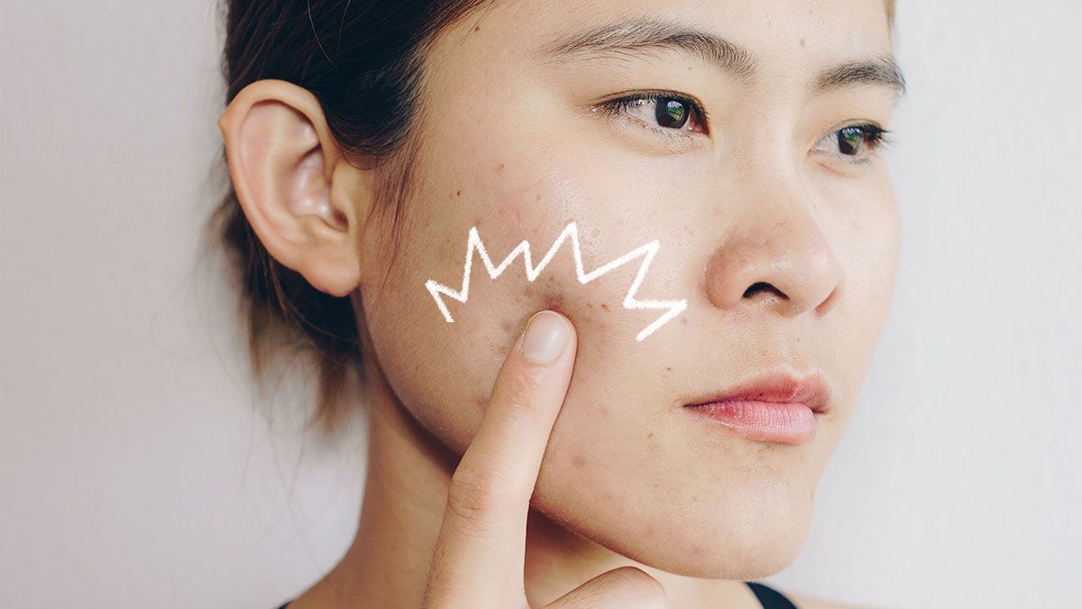 Pimpel Patches: Wir haben den Influencer Trend auf TikTok verfolgt und verraten euch, warum Ihr "herkömmliche" Blasenpflaster lieber nicht als Patches im Gesicht verwenden solltet. 