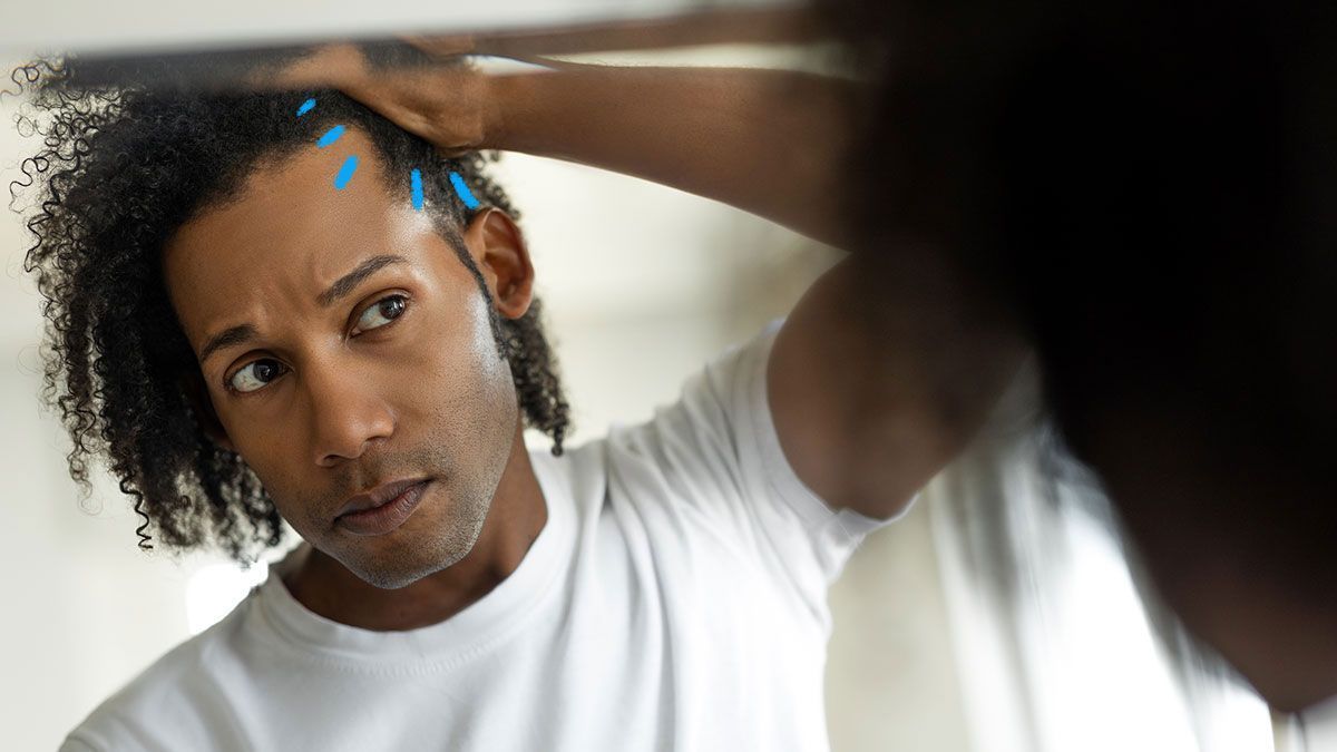 Was genau ist Haarausfall und welche verschiedenen Arten und Ursachen gibt es? Wir haben für euch die Antworten!