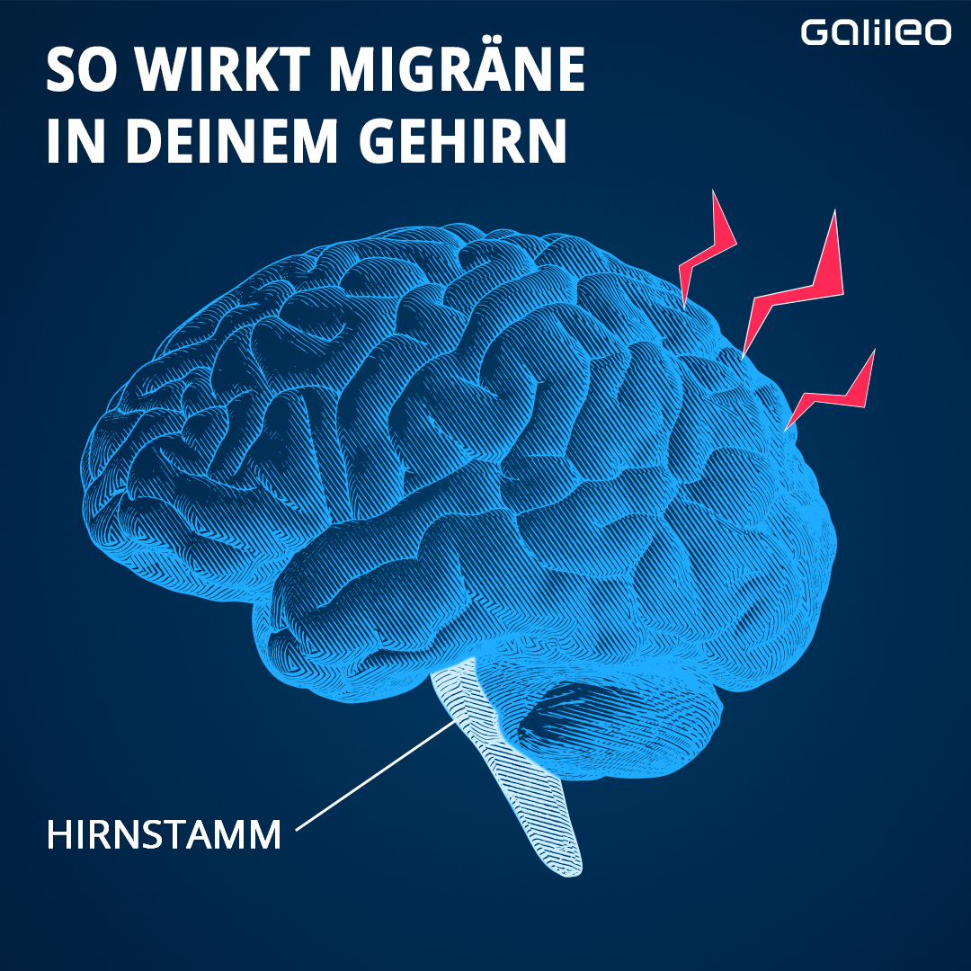 So wirkt Migräne in deinem Gehirn.