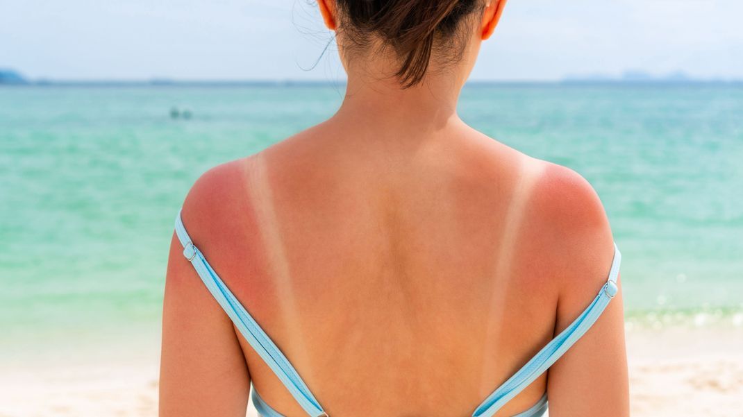 Endlich Sommer: Viele Menschen unterschätzen die Kraft der Sonne und holen sich, besonders zu Beginn des Sommers, häufig den ein oder anderen Sonnenbrand