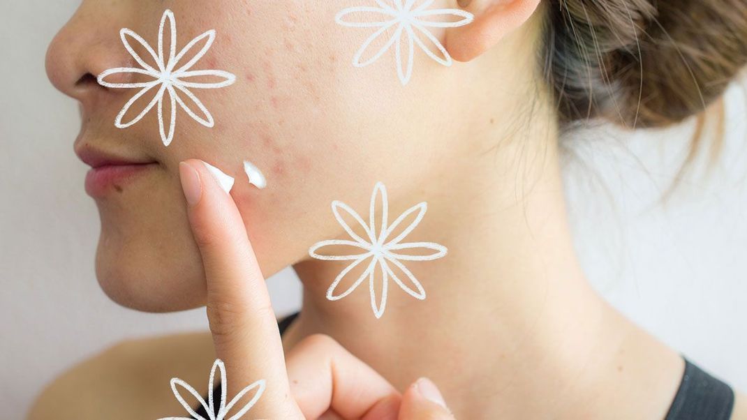 Von der richtigen Pflegecreme bis hin zur gesunden Ernährung – wir verraten euch, was ihr mit der Diagnose "Rosacea" beachten solltet. 