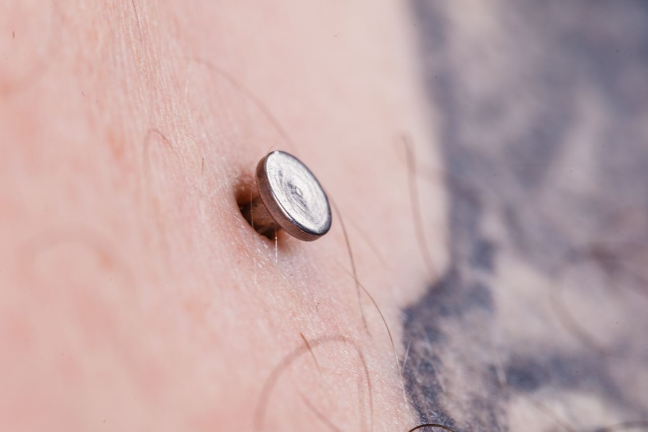 Microdermals sind Single-Point-Piercings. Sie haben also keinen Stichkanal mit Ein- und Austrittsstelle, sondern ragen nur an einem Ende aus der Haut. Sie bestehen aus einem länglichen Plättchen und einem senkrechten Stab mit Innengewinde. In dieses können verschiedene Aufsätze geschraubt werden.