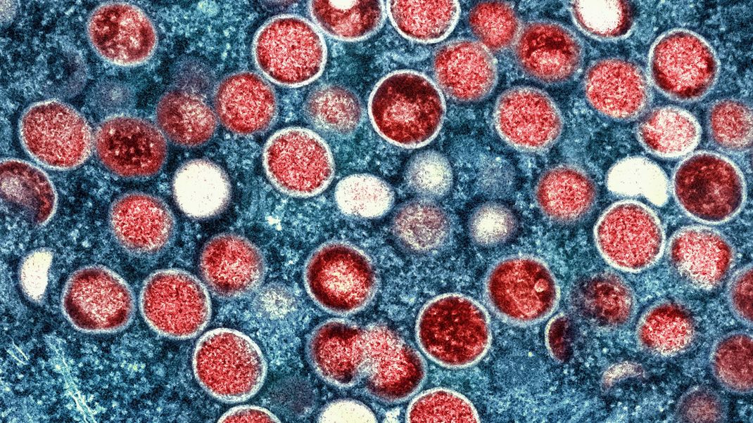 Erstmals haben sich Menschen in Europa mit der neuen Variante des Mpox-Virus angesteckt.