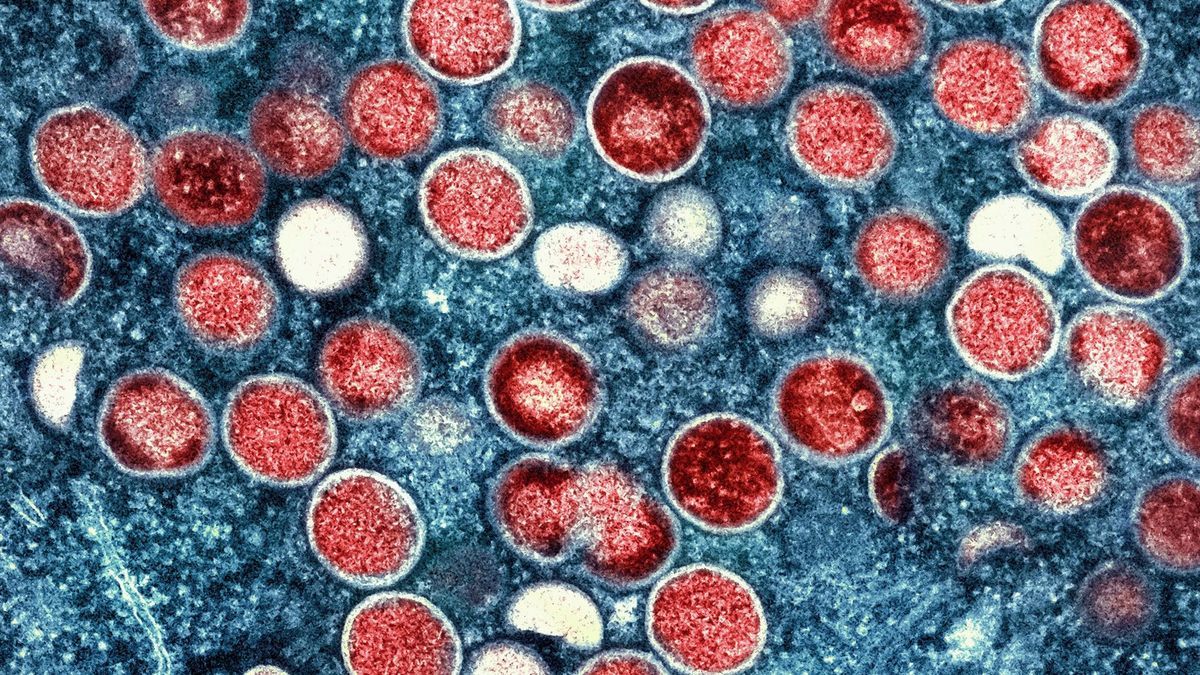 Erstmals haben sich Menschen in Europa mit der neuen Variante des Mpox-Virus angesteckt.