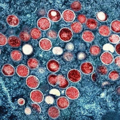 Erstmals haben sich Menschen in Europa mit der neuen Variante des Mpox-Virus angesteckt.