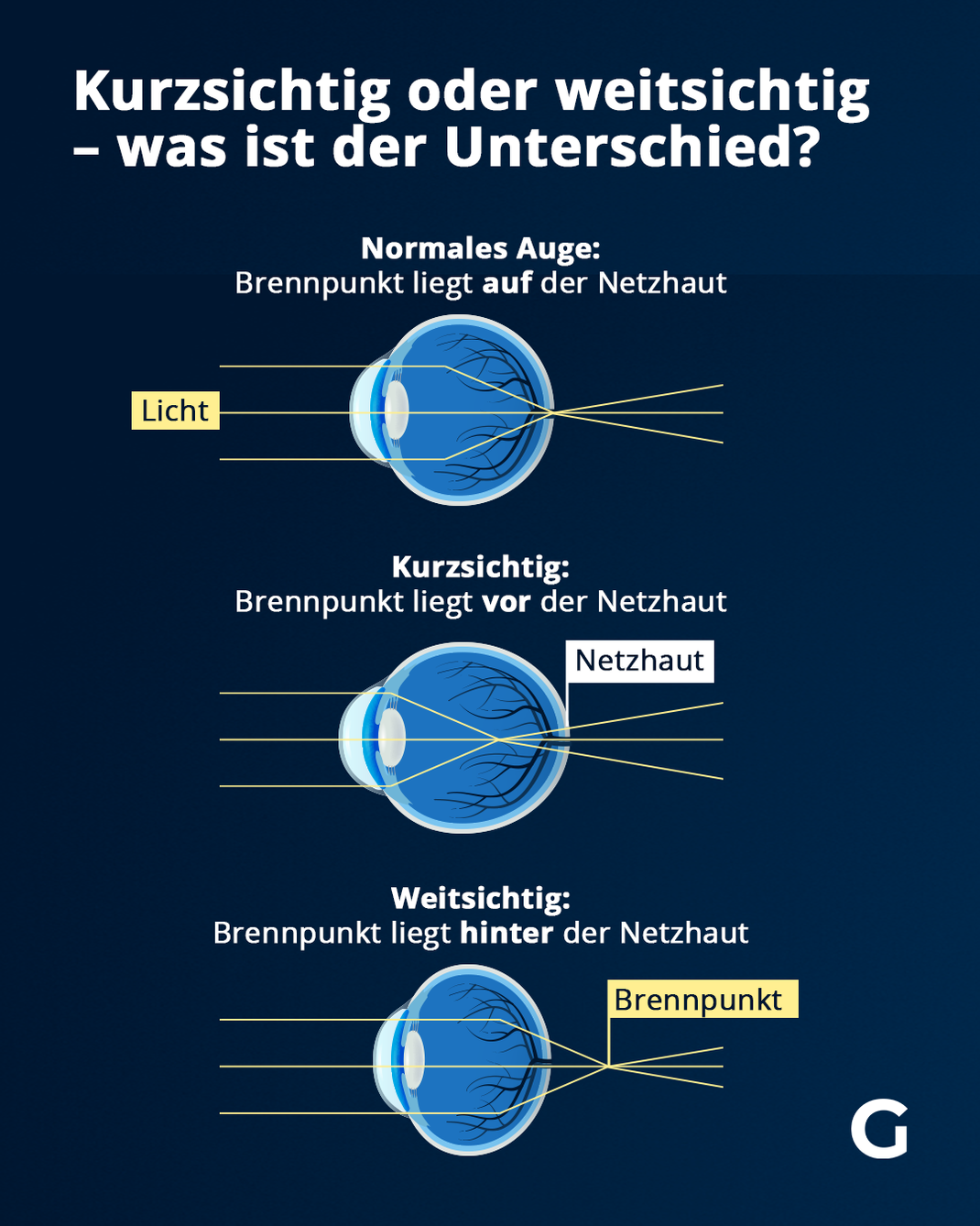 Das ist der Unterschied zwischen Kurzsichtigkeit und Weitsichtigkeit.