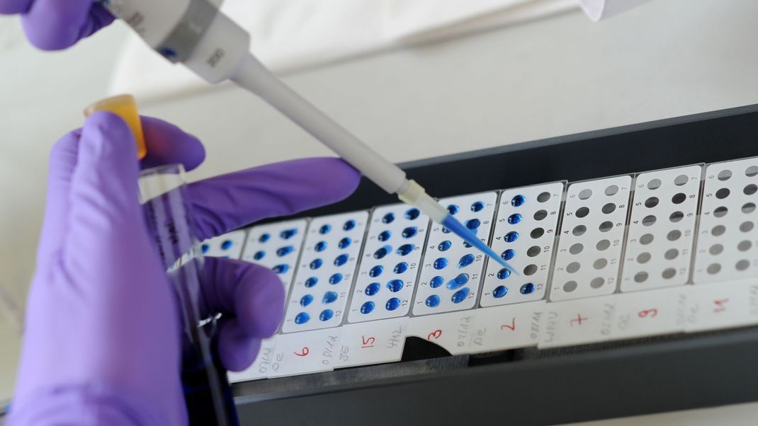 Ein Medizinisch Technischer Assistent (MTA) detektiert eine bereits abgeschlossene Antigen-Antikörper-Reaktion.
