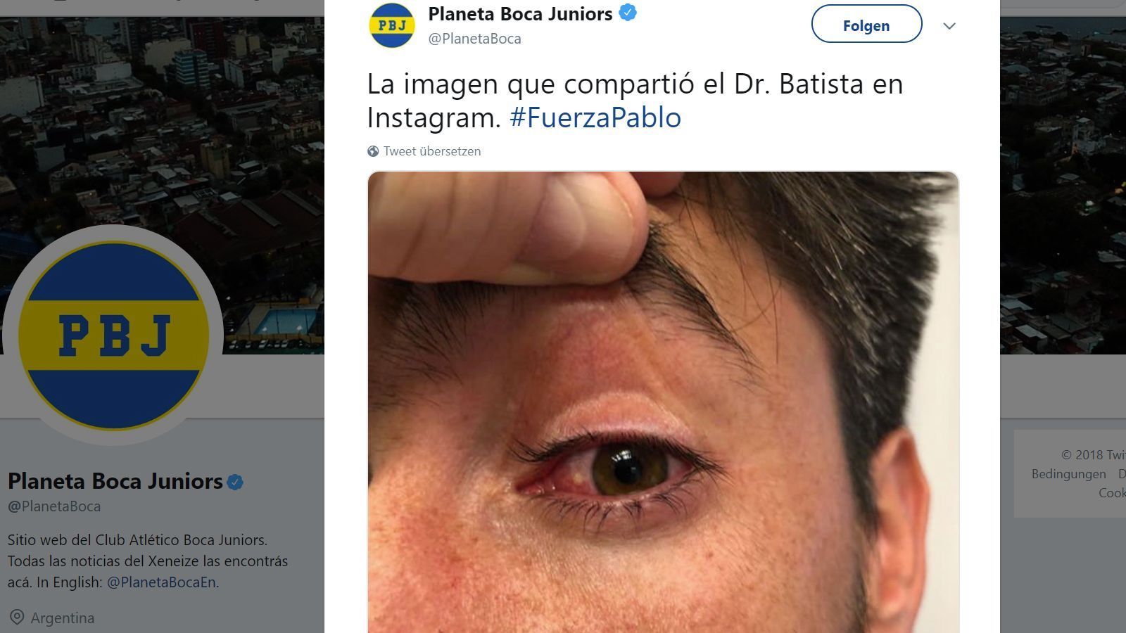 
                <strong>Boca-Kapitän erleidet Augenverletzung</strong><br>
                In der Folge wurde es immer bizarrer. Boca-Kapitän Pablo Perez wurde am Auge verletzt und wurde ins örtliche Krankenhaus gebracht. Kurze Zeit darauf kam die Order aus dem Stadion, dass der Spielführer für Untersuchungen der Verbandsärzte und für die Partie selbst zurückkehren muss.
              