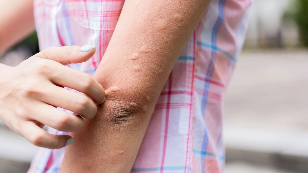 Brennende Quaddeln auf der Haut: Welche Ursachen gibt es bei Nesselsucht? Hier findet ihr die Fakten!