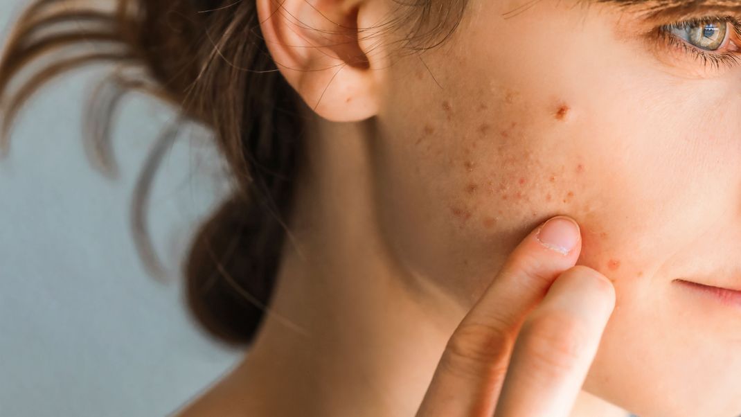 Eine gestörte Hautbarriere hat häufig Unreinheiten oder Ekzeme zur Folge. Wir haben Tipps, wie gereizte Haut wieder ins Gleichgewicht kommt.