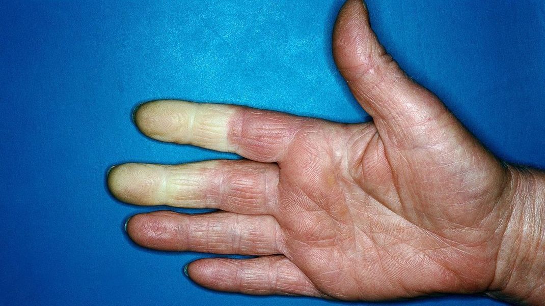 Weiße Glieder an den Fingern sind ein untrügliches Merkmal für das Raynaud-Syndrom.
