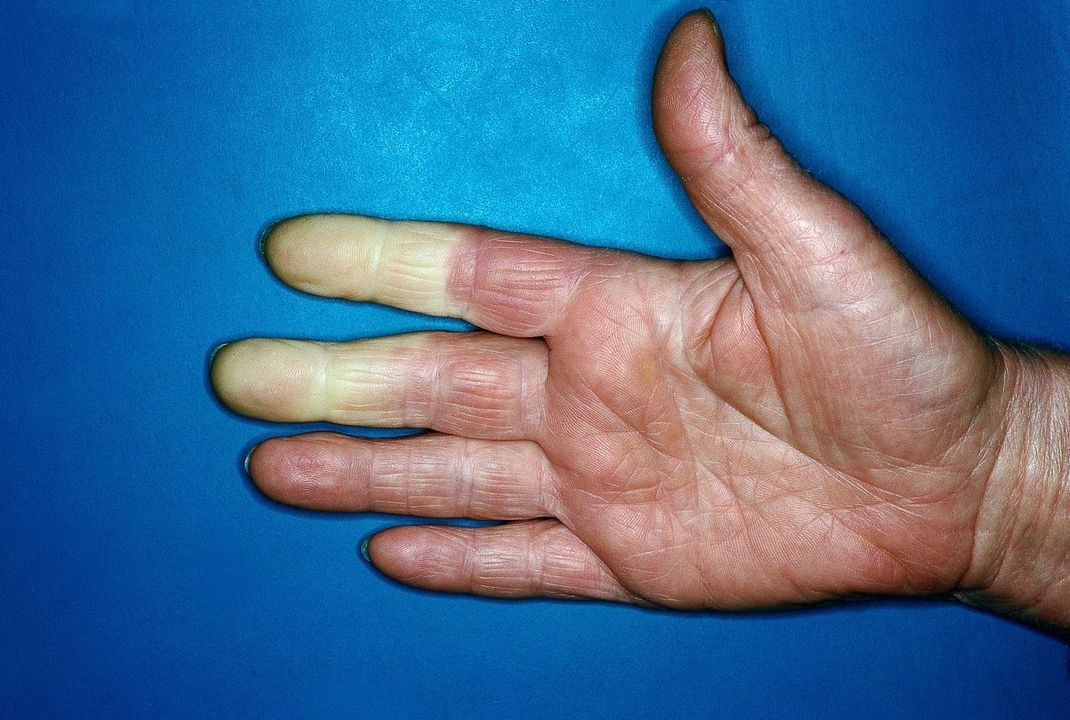 Weiße Glieder an den Fingern sind ein untrügliches Merkmal für das Raynaud-Syndrom.