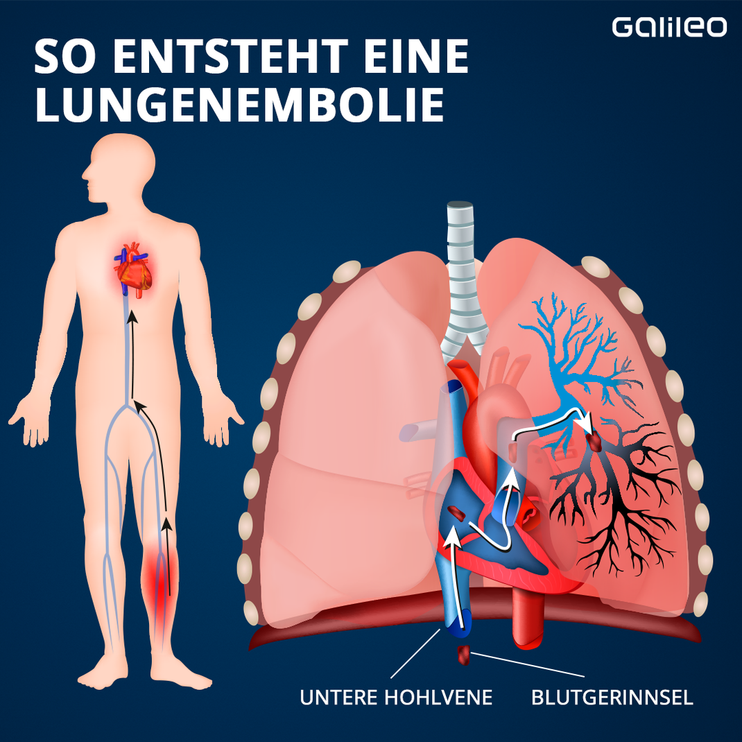 Von der Beinvene wandert das Blutgerinnsel über das Herz in die Lunge. Dort verstopft es ein Gefäß . Es kommt zur Lungenembolie.