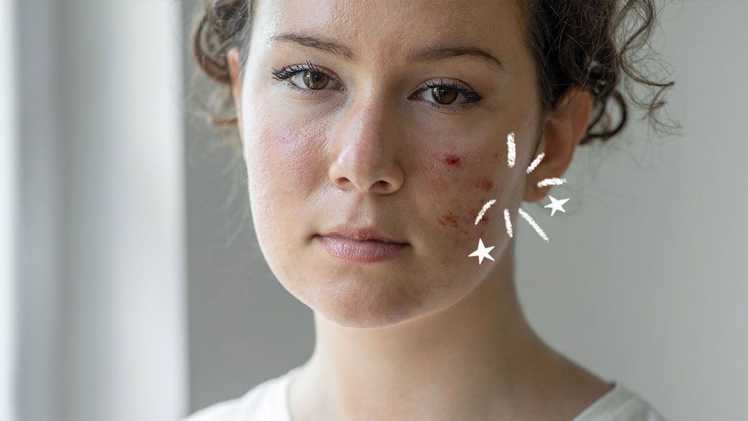 Rote Flecken im Gesicht, die auf eine nicht ansteckende Hauterkrankung zurückzuführen sind - hier lest ihr die Fakten zur Rosazea-Gesichtsrötung.