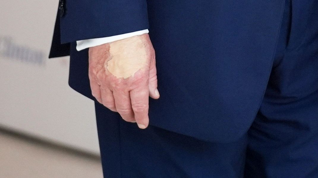 Ein Fleck auf der Hand von US-Präsident Donald Trump sorgt für Spekulationen über seinen Gesundheitszustand. 