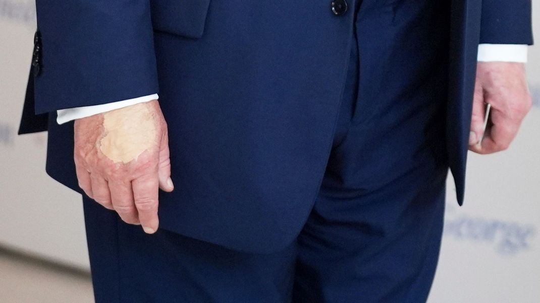 Die Hand von US-Präsident Donald Trump weist einen seltsamen Fleck auf.