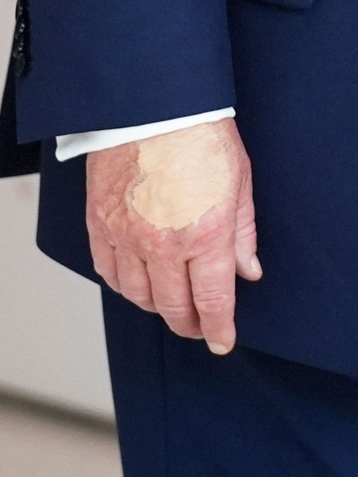 Ein Fleck auf der Hand von US-Präsident Donald Trump sorgt für Spekulationen über seinen Gesundheitszustand. 