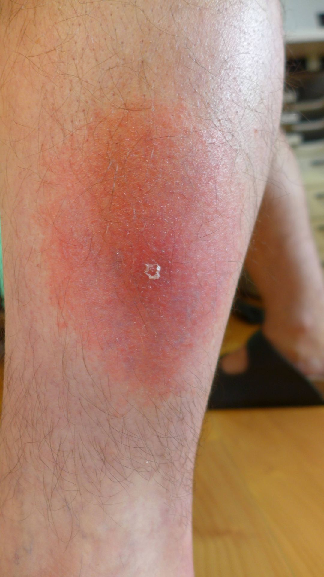 So sieht eine Borrelioseinfektion an einem Bein nach einem Zeckenbiss aus.