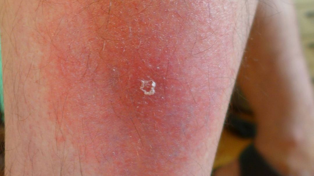 So sieht eine Borreliose-Infektion an einem Bein nach einem Zeckenbiss aus.