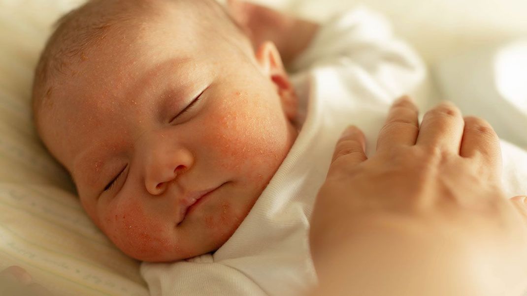 Was sind Hitzepickel und warum können auch Babies darunter leiden? Die Antworten findet ihr im Beauty-Artikel.