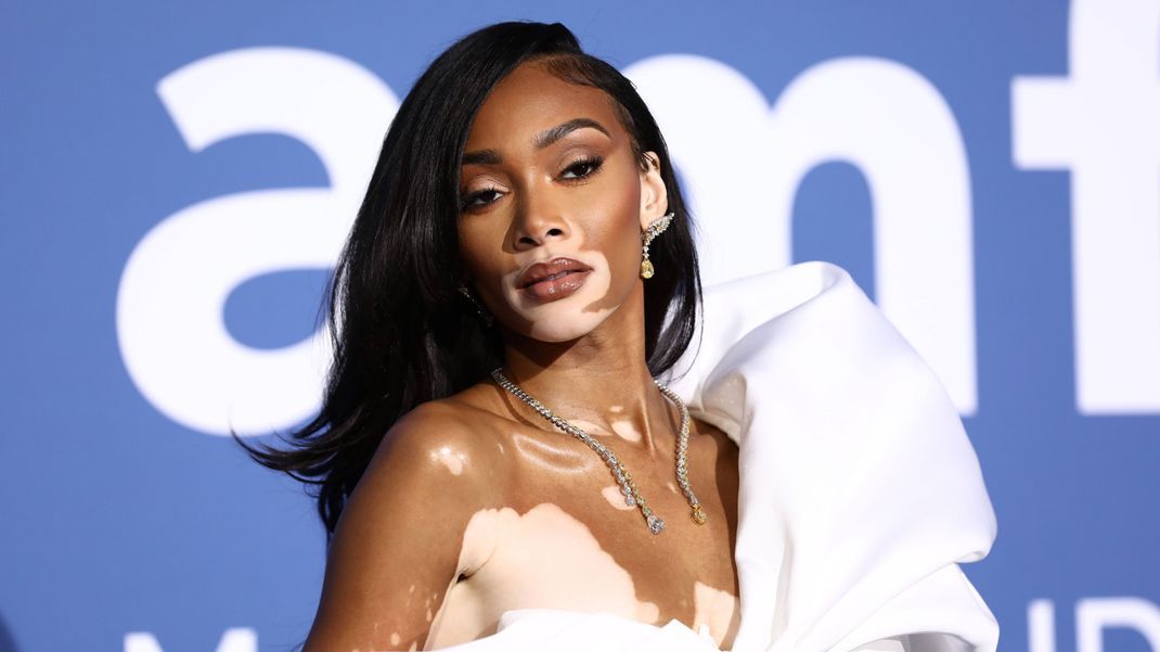 Die Pigment-Störung Vitiligo wurde zum Markenzeichen des Supermodels Winnie Harlow.