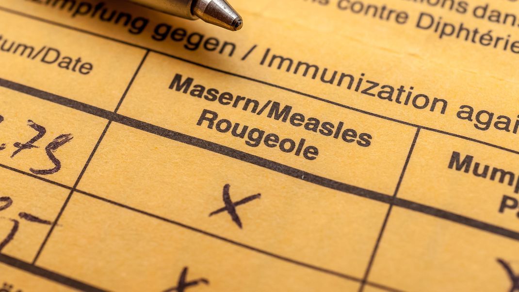 Die Zahl der Masern-Infektionen in Nordrhein-Westfalen ist stark angestiegen.