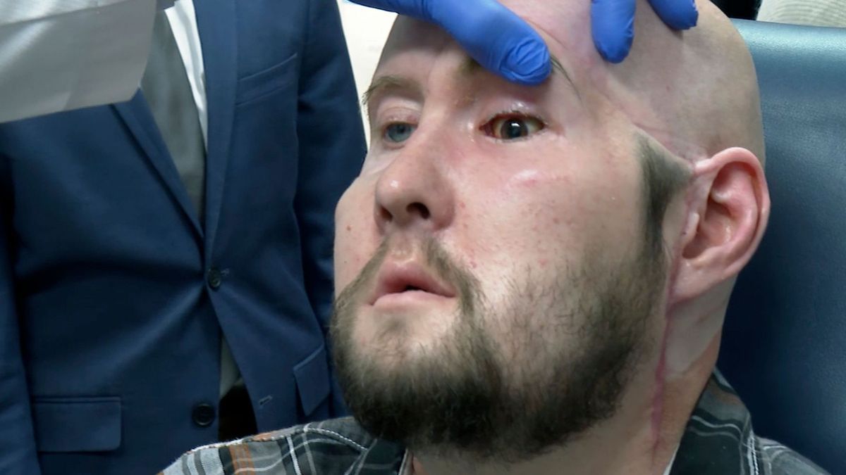 US-Veteran erhält weltweit erste Augentransplantation