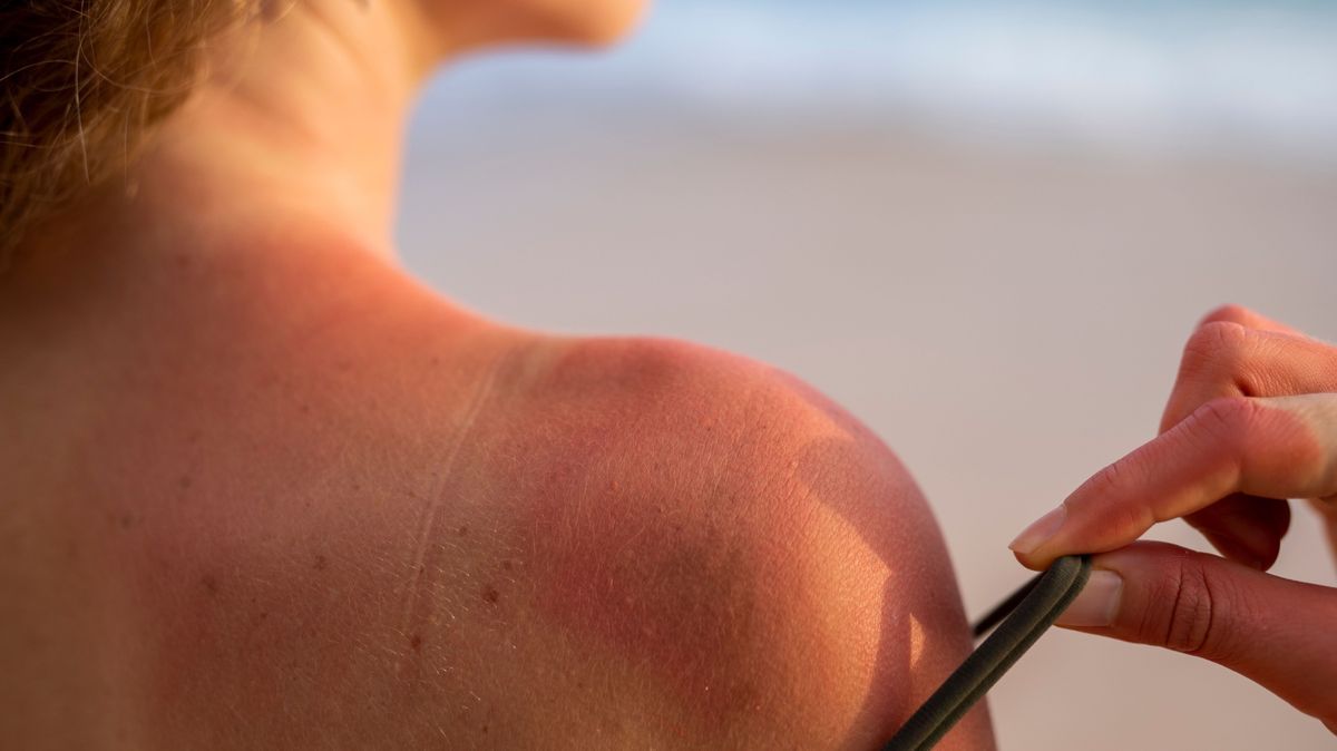 Autsch! Sonnenbrand ist fies - zum Glück gibt es Hausmittel, die Linderung versprechen.