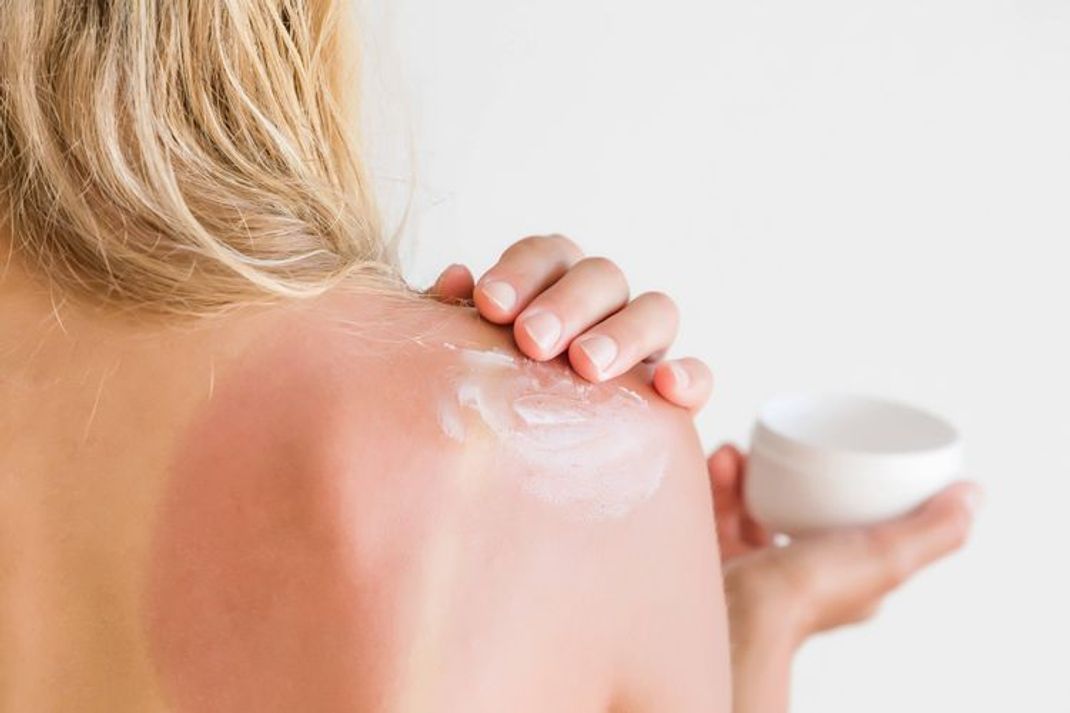 Sonnenbrand – diese Hausmittel  helfen wirklich
