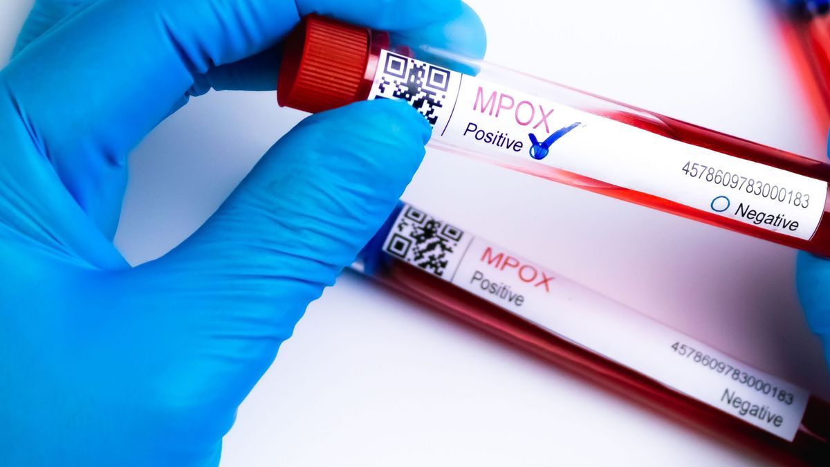 flasks with blood tests for monkey pox virus positive and negative, mpox