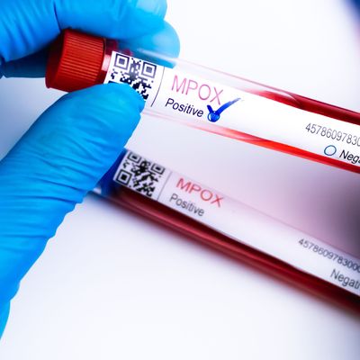 flasks with blood tests for monkey pox virus positive and negative, mpox