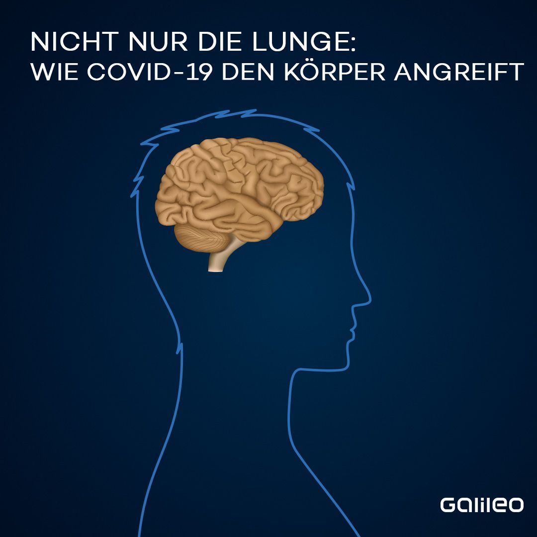 Auch das Gehirn kann betroffen sein: Erste wissenschaftliche Studien legen nahe, dass auch das zentrale Nervensystem geschädigt werden kann. Neurologische Symptome von Covid-19-Patienten sind beispielsweise Kopfschmerzen, Schwindel, Sinnesausfälle oder sogar Krämpfe und Schlaganfälle.