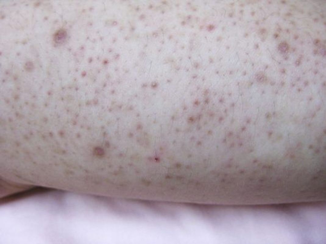 Nahaufnahme von einem Arm mit Keratosis pilaris, auch Reibeisenhaut oder Erdbeerhaut genannt.