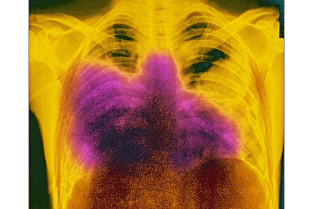 Röntgenbild einer Lunge mit akutem Legionellenbefall (Legionärskrankheit). In lila ist das entzündete Lungengewebe abgebildet. 