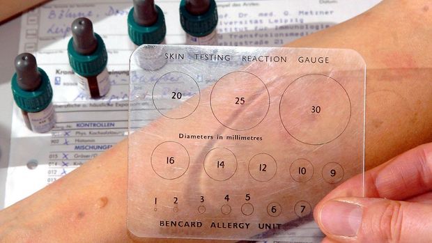 Allergen-Test_dpa - Bildfunk