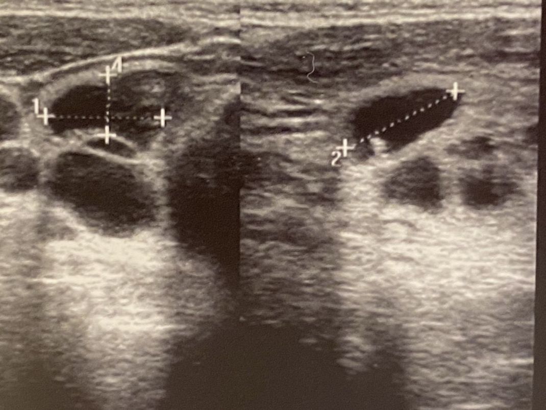 Auf dem Ultraschallbild ist eine Zyste in der Schilddrüse klar erkennbar.
