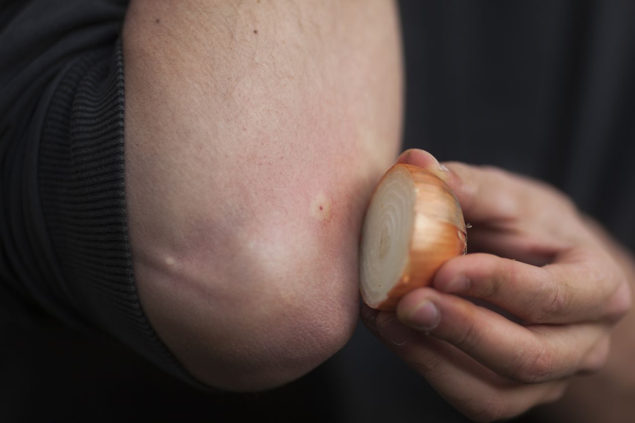 Zwiebeln sollen Juckreiz lindern. Schneide sie frisch auf und drücke sie auf den Stich.