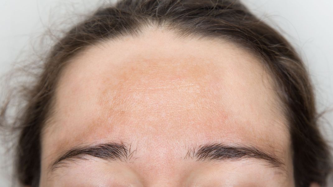 Wer täglich Sonnenschutz verwendet, beugt Pigmentflecken auf Stirn oder Wangen vor.