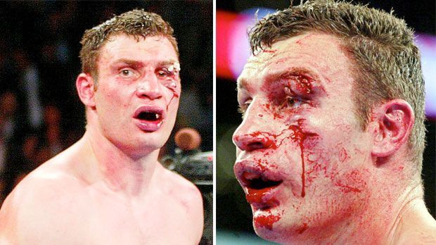 
                <strong>Vitali Klitschko vs. Lennox Lewis (2003)</strong><br>
                Vitali Klitschko vs. Lennox Lewis (2003): Wegen mehrerer stark blutender Platzwunden am Auge wurde der Kampf gegen Weltmeister Lewis in Runde sechs abgebrochen und Lewis zum Sieger erklärt. Sowohl die Zuschauer im Staples Center von Los Angeles als auch Ex-Weltmeister George Foreman sahen in Klitschko den wahren Sieger, da er bei Kampfabbruch auf allen drei Punktzetteln vorne lag.
              