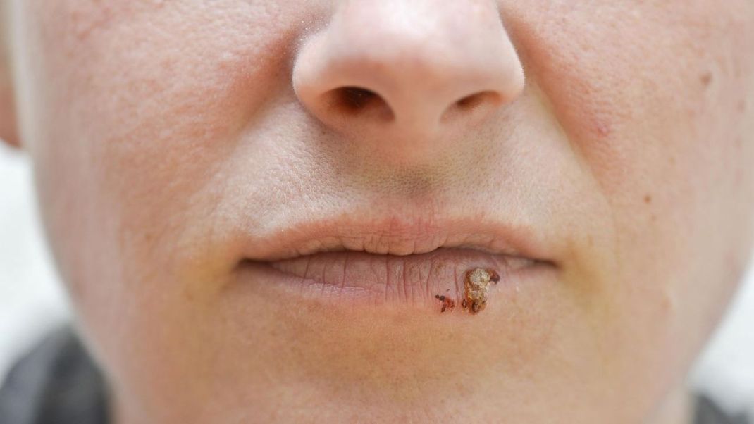An den Stellen, wo sich die Herpes-Bläschen bilden, können Schmerzen auftreten. Die Haut wird rot und spannt. Es entstehen in weiterer Folge kleine, mit Flüssigkeit gefüllte Fieberblasen.