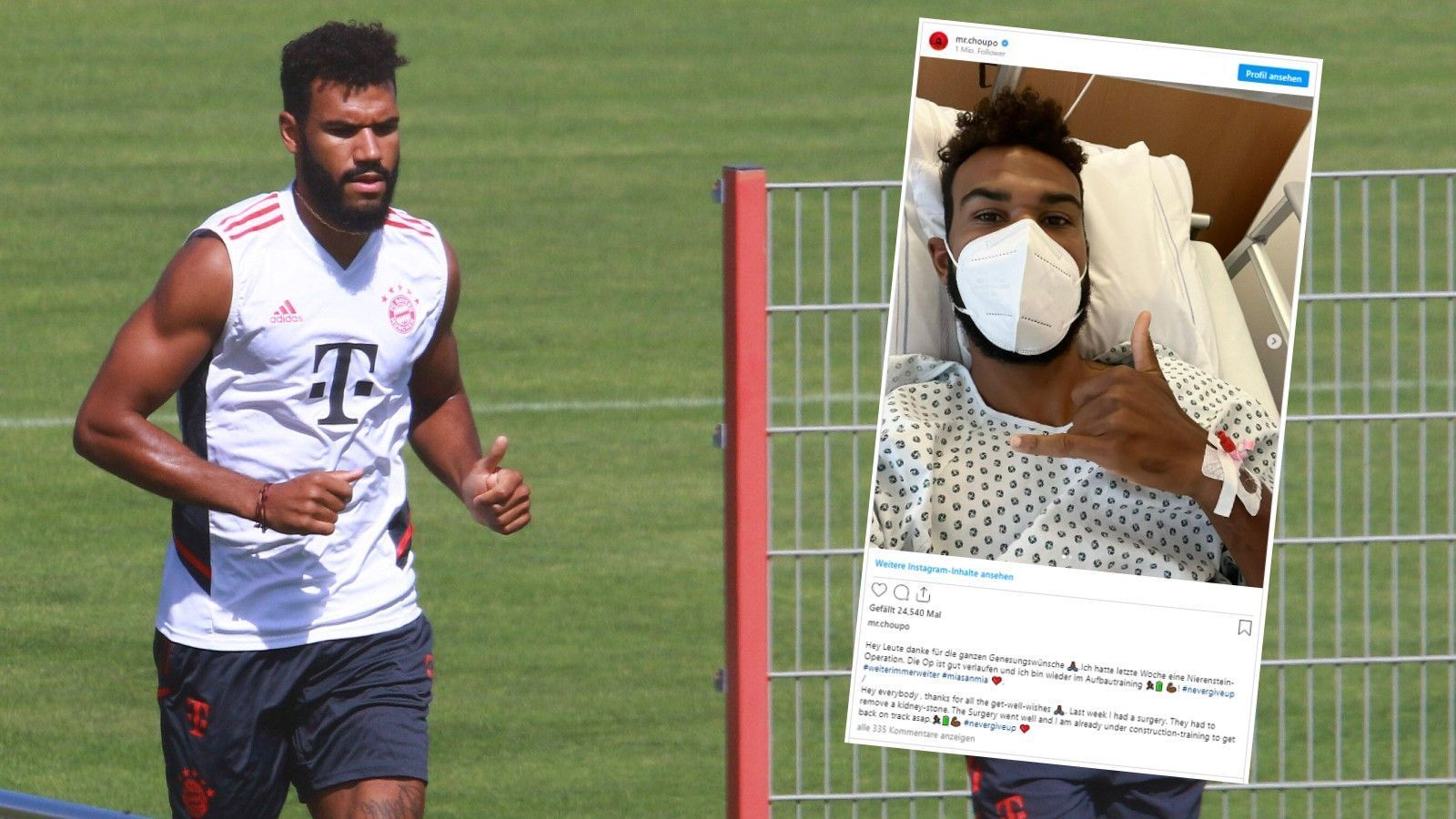 
                <strong>Bayern-Star Choupo-Moting enthüllt Operation</strong><br>
                Überraschung bei Eric Maxim Choupo-Moting: Der Bayern-Stürmer wurde während der Vorbereitung auf die neue Saison operiert. Bei Instagram postete der 33-Jährige ein Bild aus dem Krankenbett. Dazu formulierte der Angreifer: "Ich hatte letzte Woche eine Nierenstein-Operation. Die OP ist gut verlaufen und ich bin wieder im Aufbautraining." Warum Choupo-Moting den Bayern zuletzt nicht wie gewohnt zur Verfügung stand, war bis dahin nicht klar. Vermehrt wurde von Leisten- und Hüftproblemen gesprochen. Beim Bundesliga-Auftakt am Abend gegen Eintracht Frankfurt (ab 19:00 Uhr live in SAT.1 und auf ran.de) ist er noch keine Option.
              