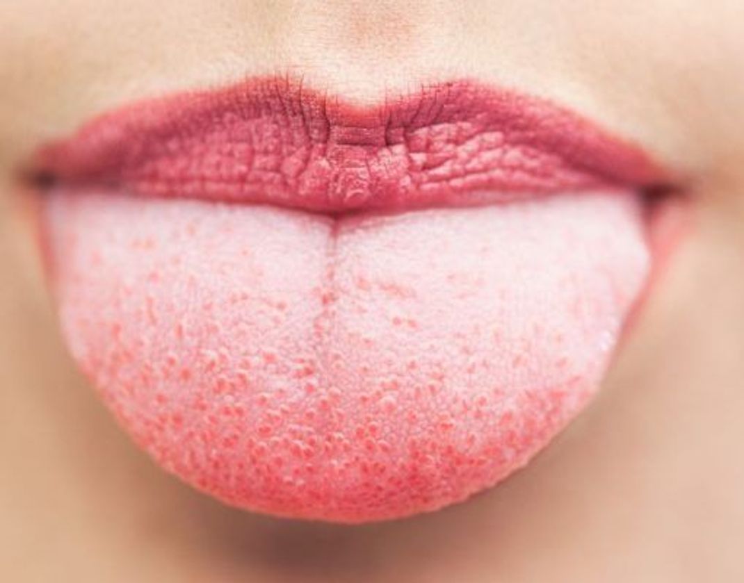 Auf der Zunge befinden sich unzählige Geschmackspapillen mit den Geschmacksknospen.