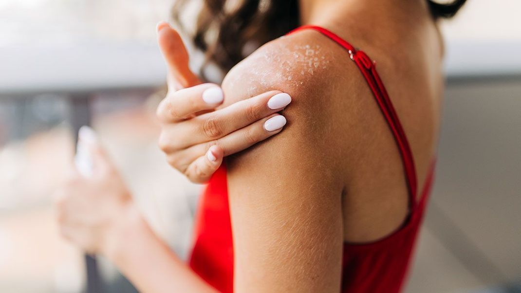 Findet heraus, wie ihr Sonnenbrand und leichte Verbrennungen auf der Haut nach dem Sonnenbaden vermeiden könnt.