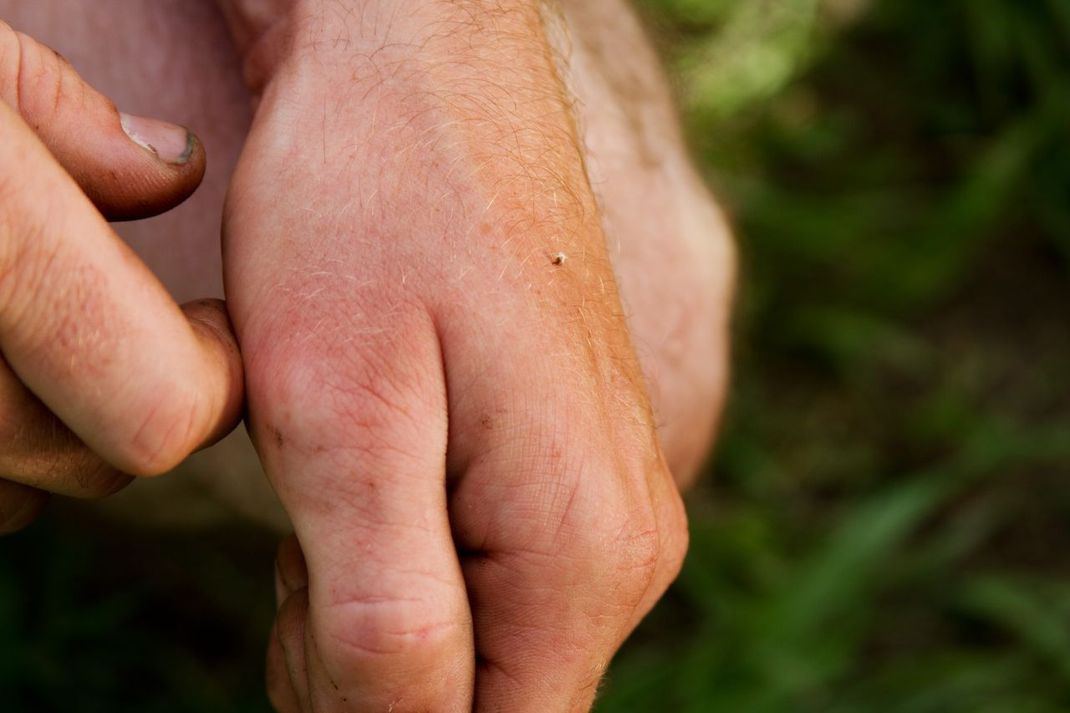 Siehst du den Stachel in der Hand? Das spricht für einen Bienenstich. Wenn eine Biene sticht, verliert sie ihren Stachel - und stirbt. Eine Wespe hingegen behält ihren Stachel und lebt weiter.