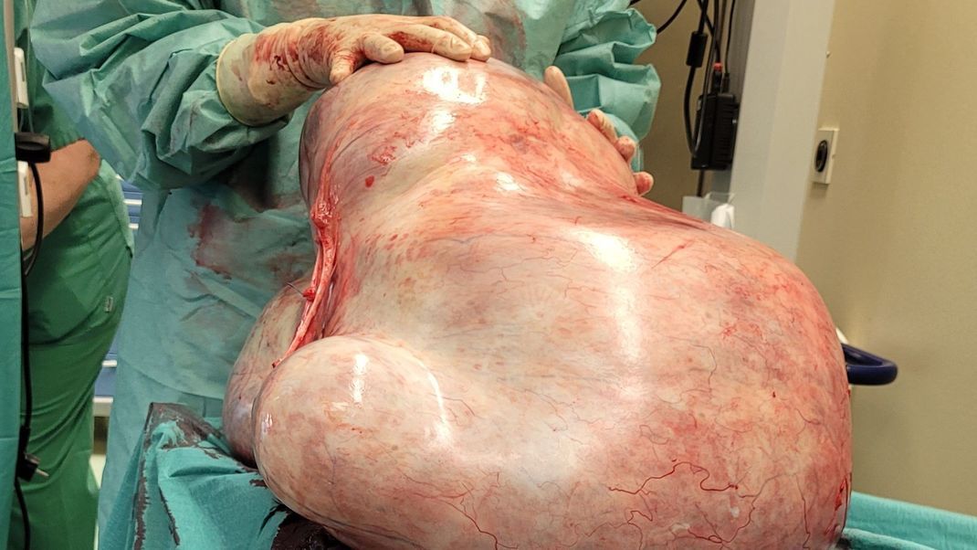 Sensation an der Uniklinik Magdeburg: Dieser 32 Kilogramm schwere Tumor musste einer jungen Frau aus den Eierstöcken entfernt werden.